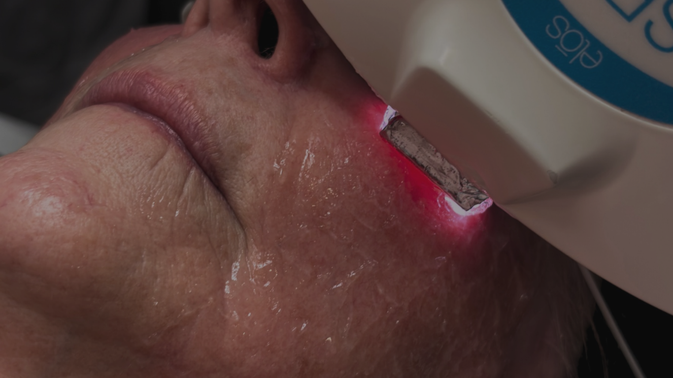 SRA laser photofacial at Ambiance Spa in Houston