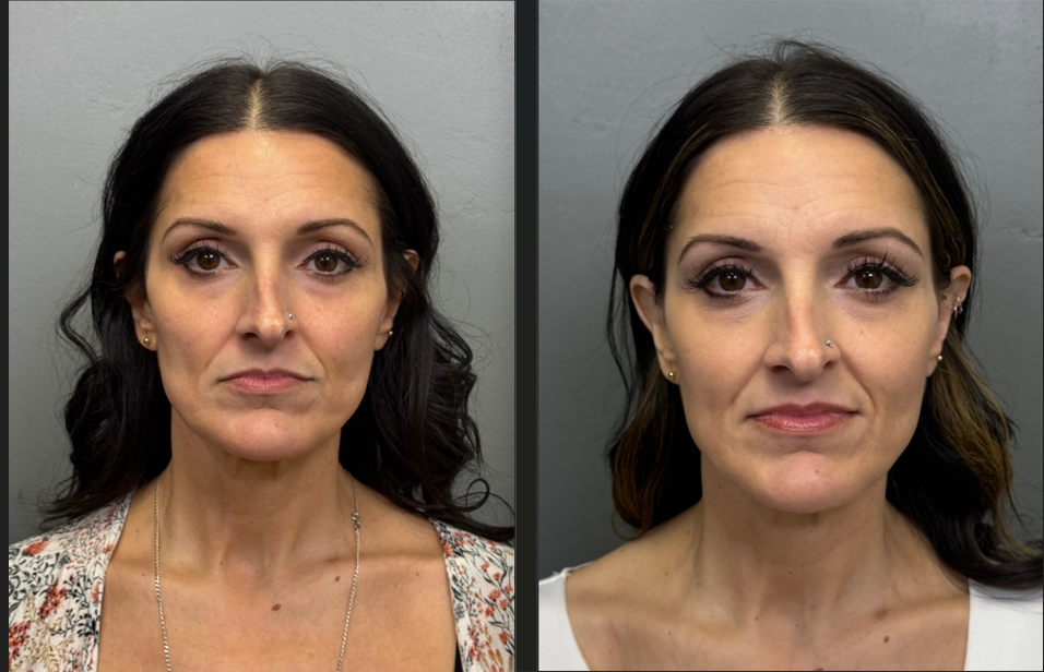 Sunrise patient before and after Sculptra
