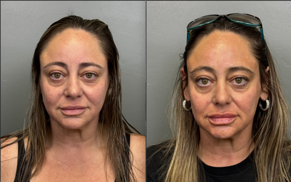 Sunrise patient before and after CO2 combined with lip filler