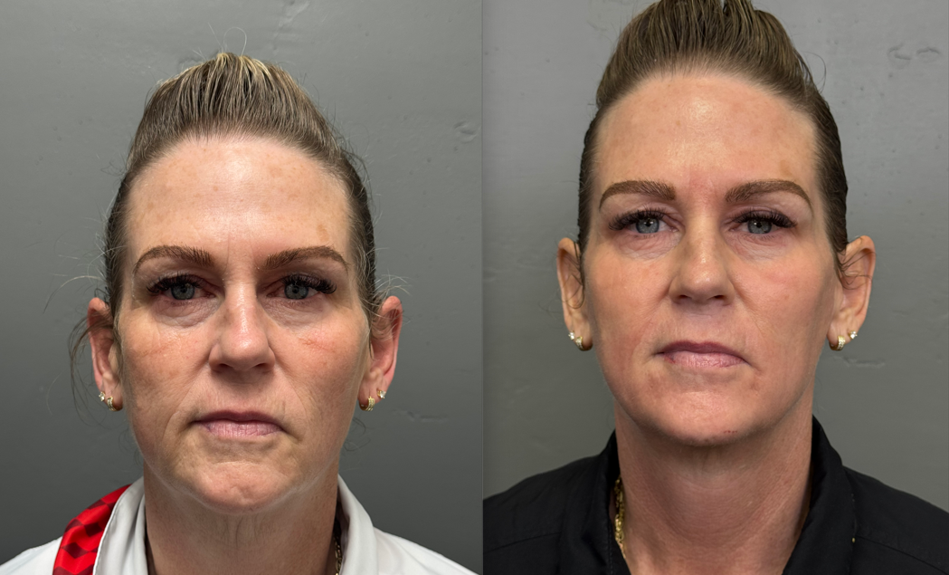 Sunrise patient before and after CO2 with topical Sculptra