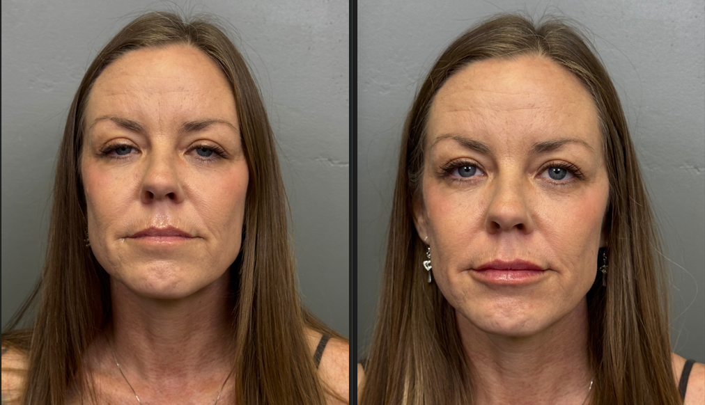 Sunrise patient before and after lip filler
