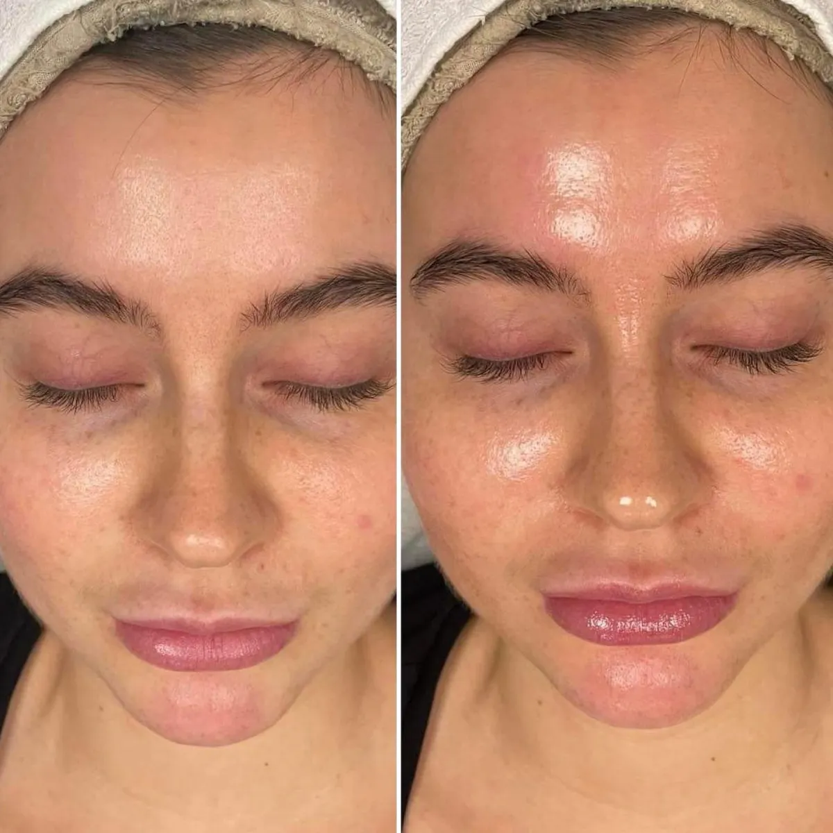 Microneedling resultat 4