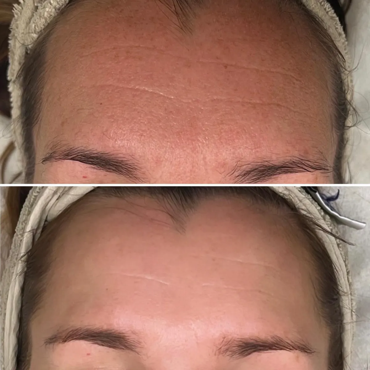 Microneedling resultat 2
