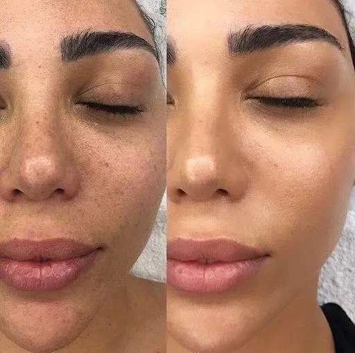 Microneedling resultat 1