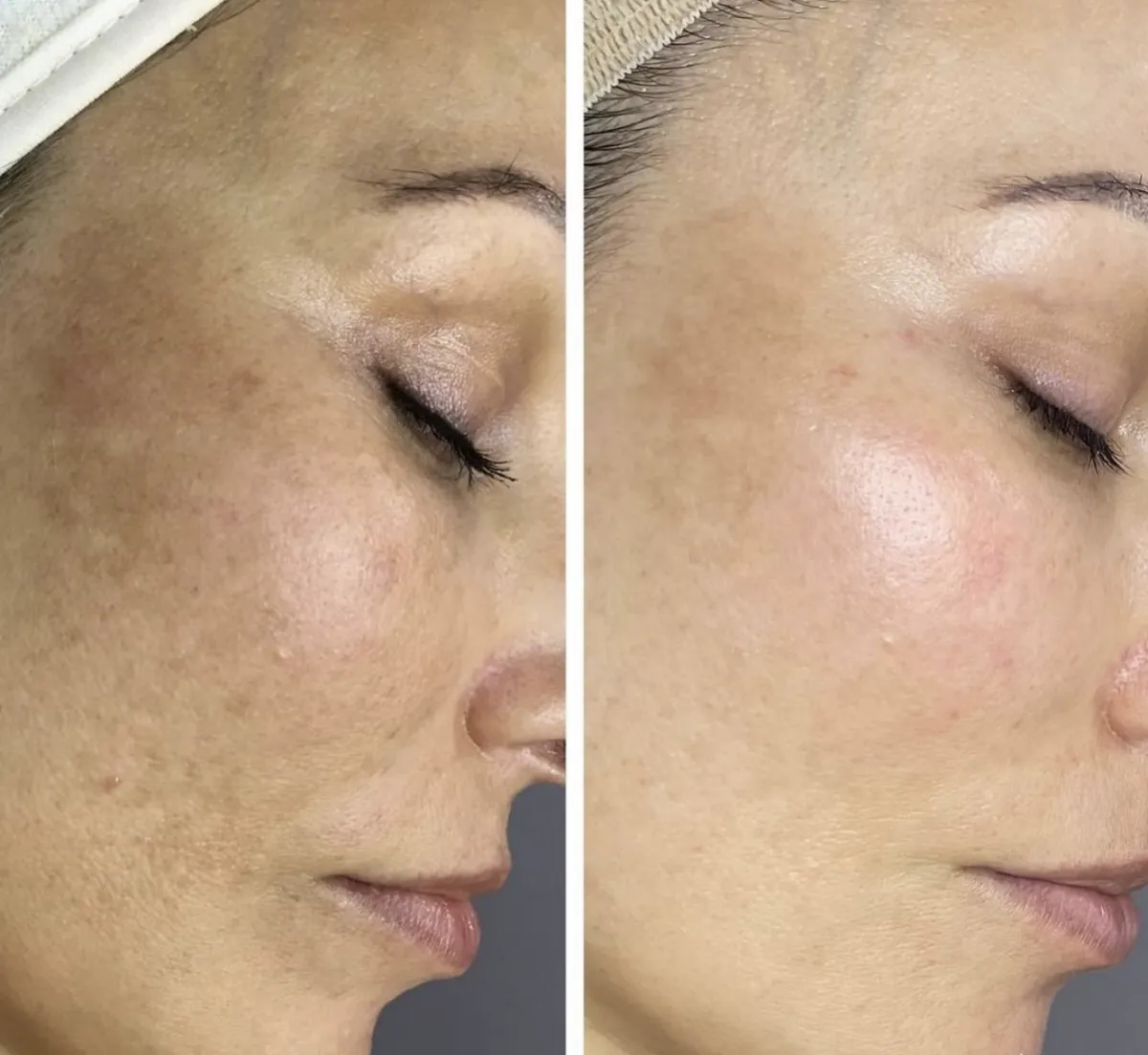 Microneedling resultat 3