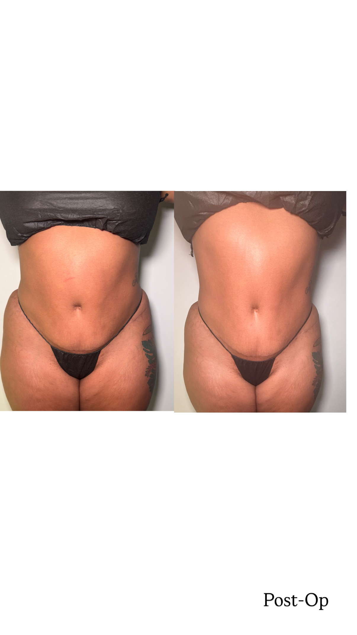 Brazilian Lymphatic Drainage with Colombian Wood Therapy