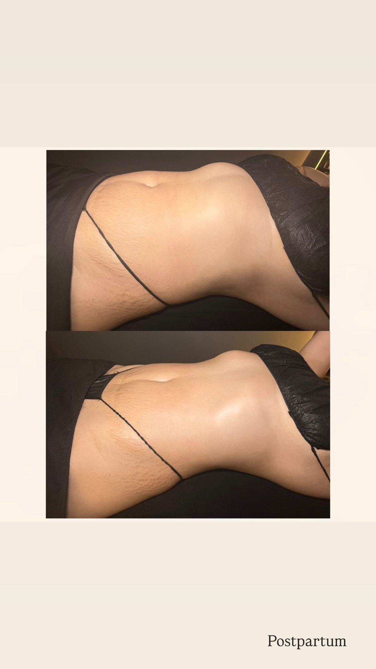Brazilian Lymphatic Drainage with Colombian Wood Therapy