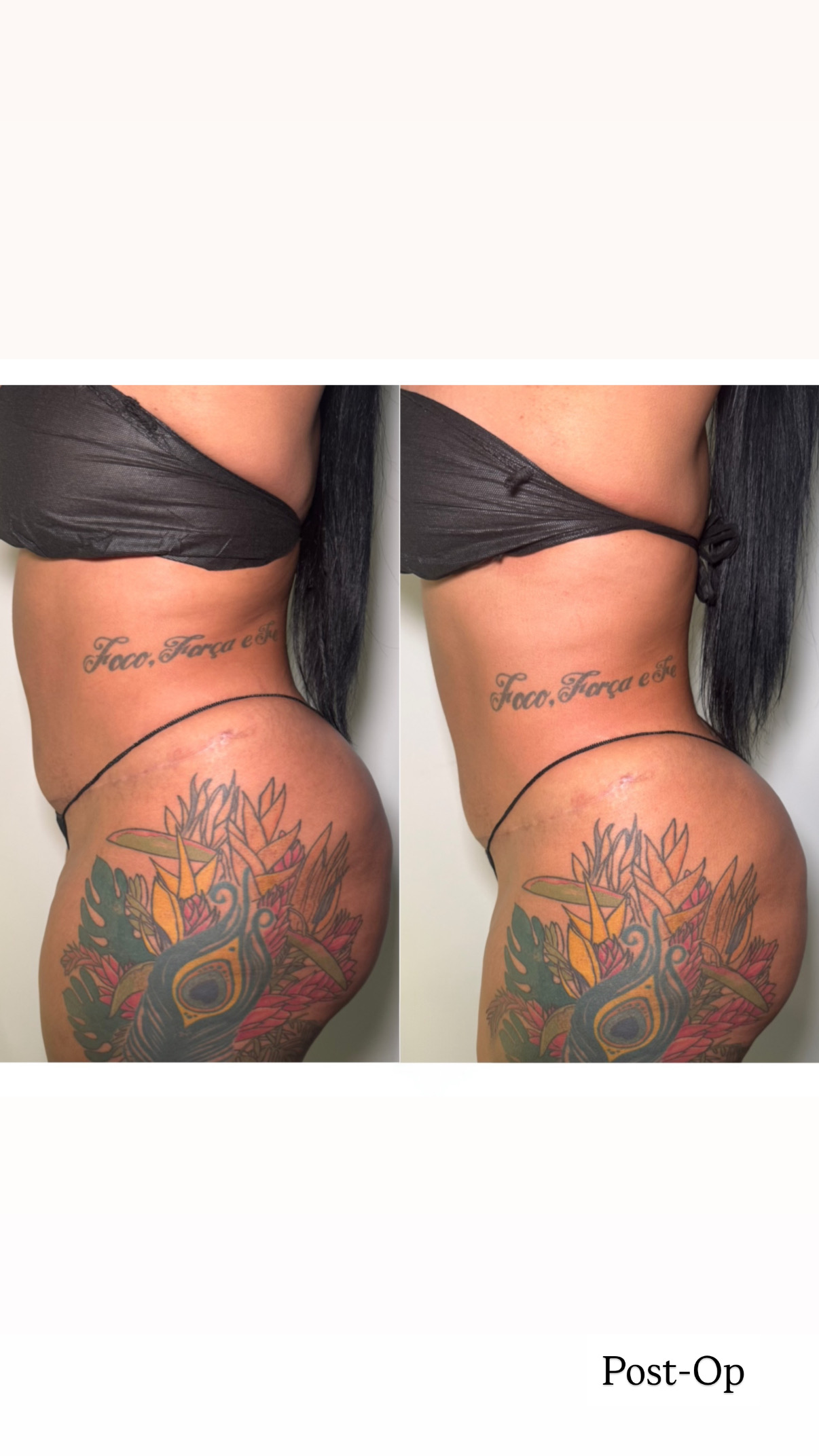 Brazilian Lymphatic Drainage with Colombian Wood Therapy
