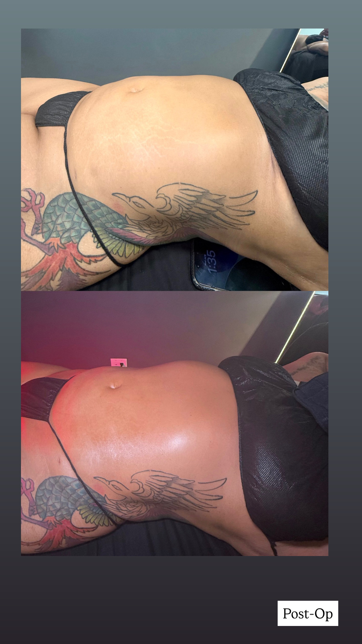 Brazilian Lymphatic Drainage with Colombian Wood Therapy