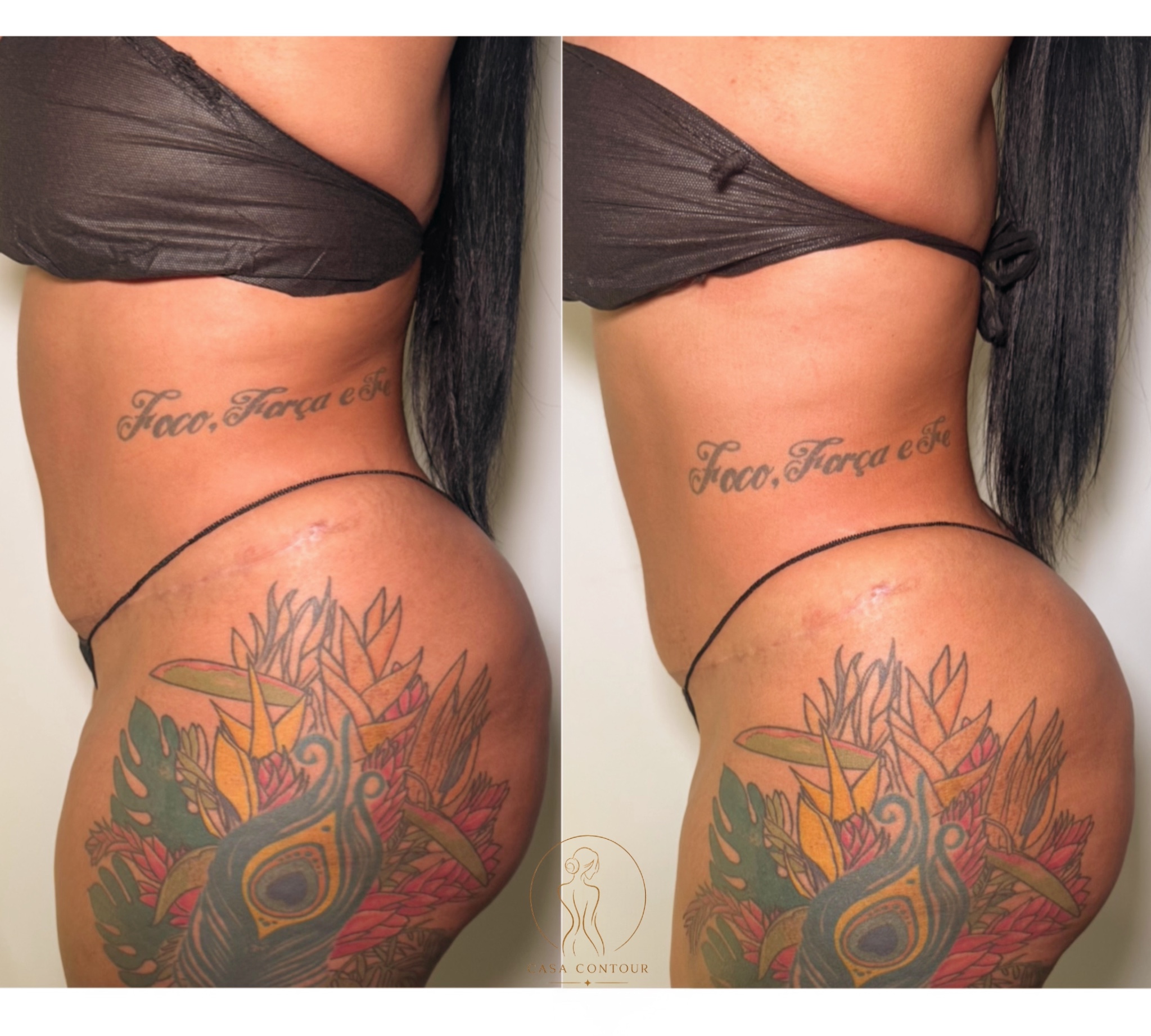 Brazilian Lymphatic Drainage with Colombian Wood Therapy