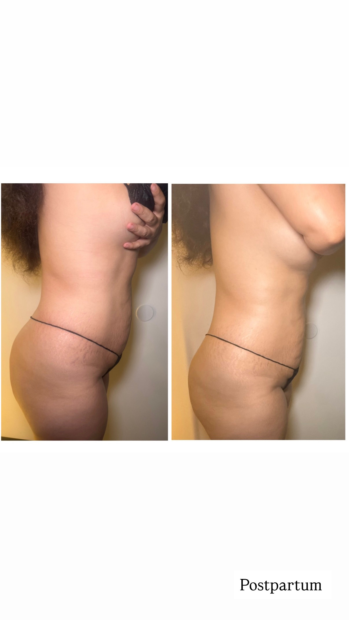 Brazilian Lymphatic Drainage with Colombian Wood Therapy