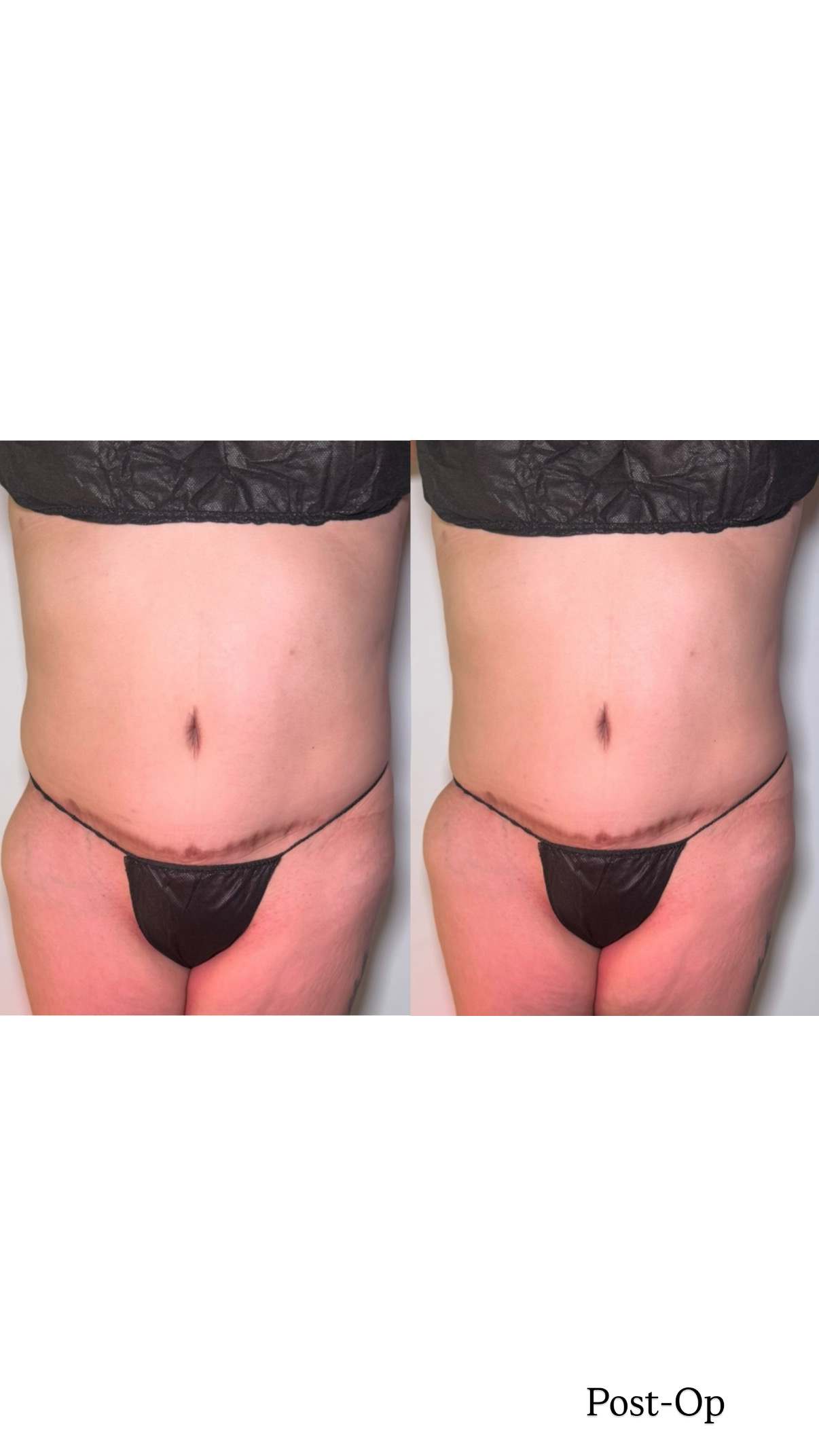 Postoperative Lymphatic Care in Edmonton