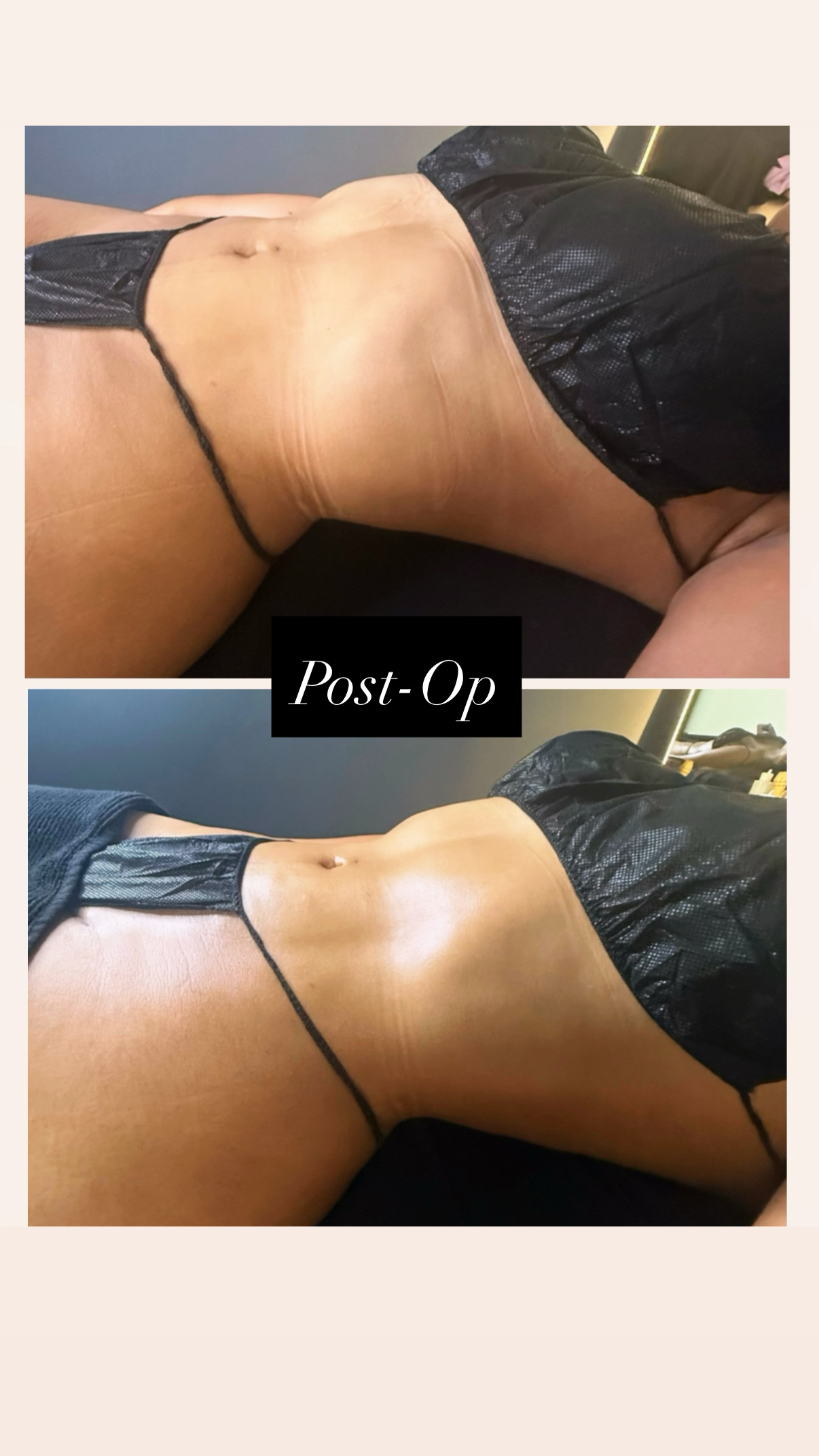Brazilian Lymphatic Drainage with Colombian Wood Therapy