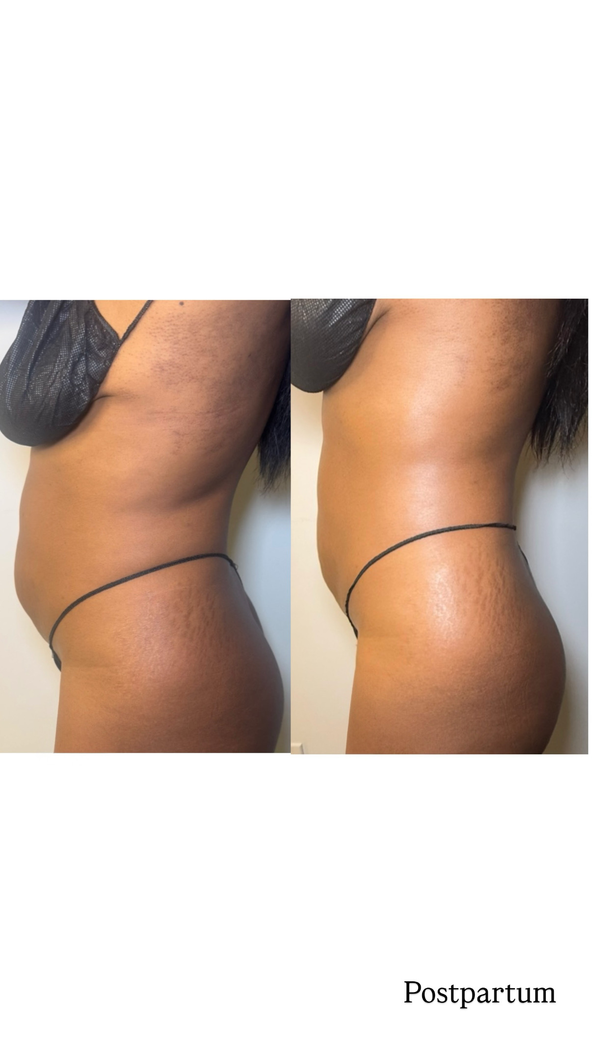 Brazilian Lymphatic Drainage with Colombian Wood Therapy