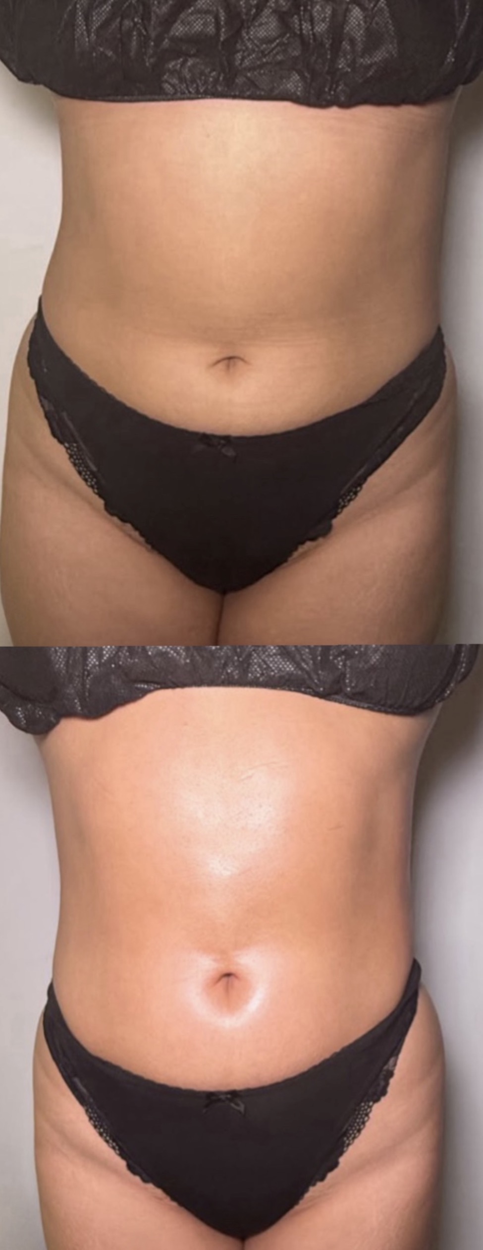 Brazilian Lymphatic Drainage with Colombian Wood Therapy