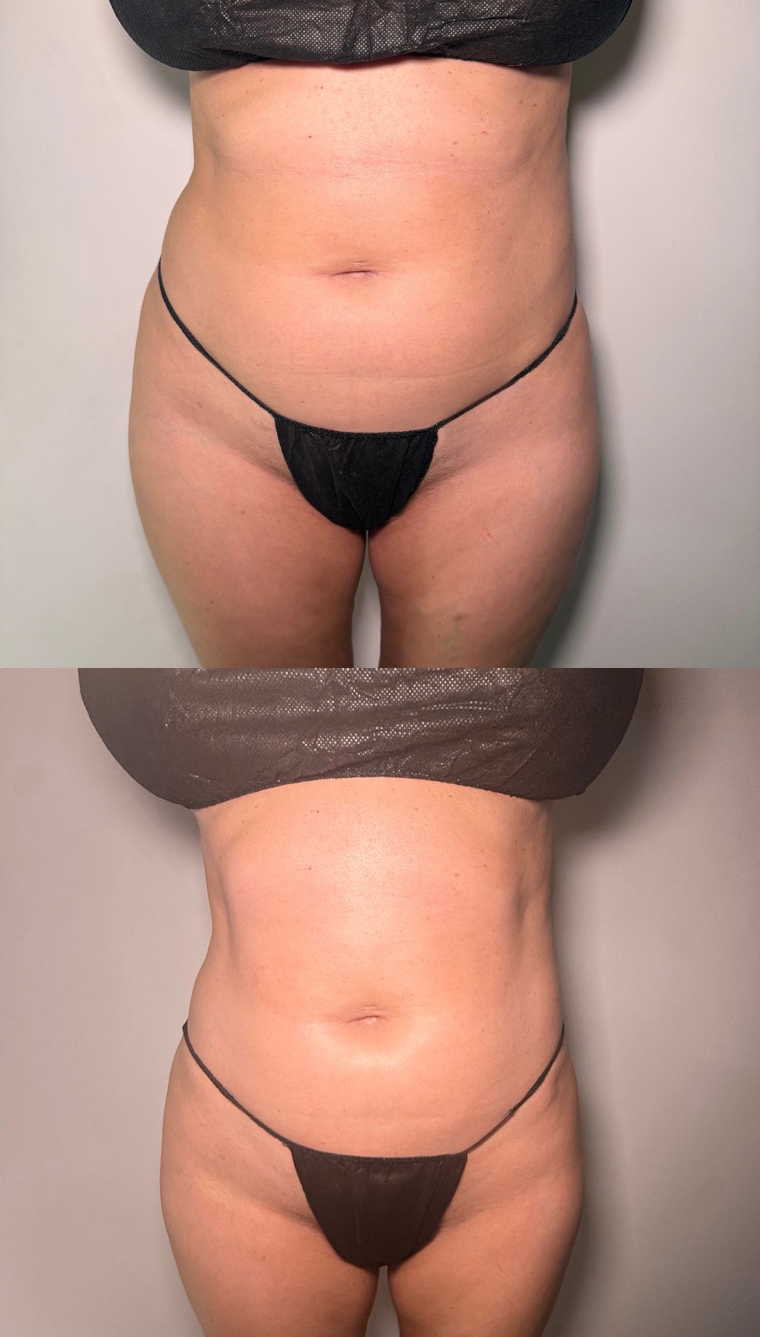 Brazilian Lymphatic Drainage with Colombian Wood Therapy