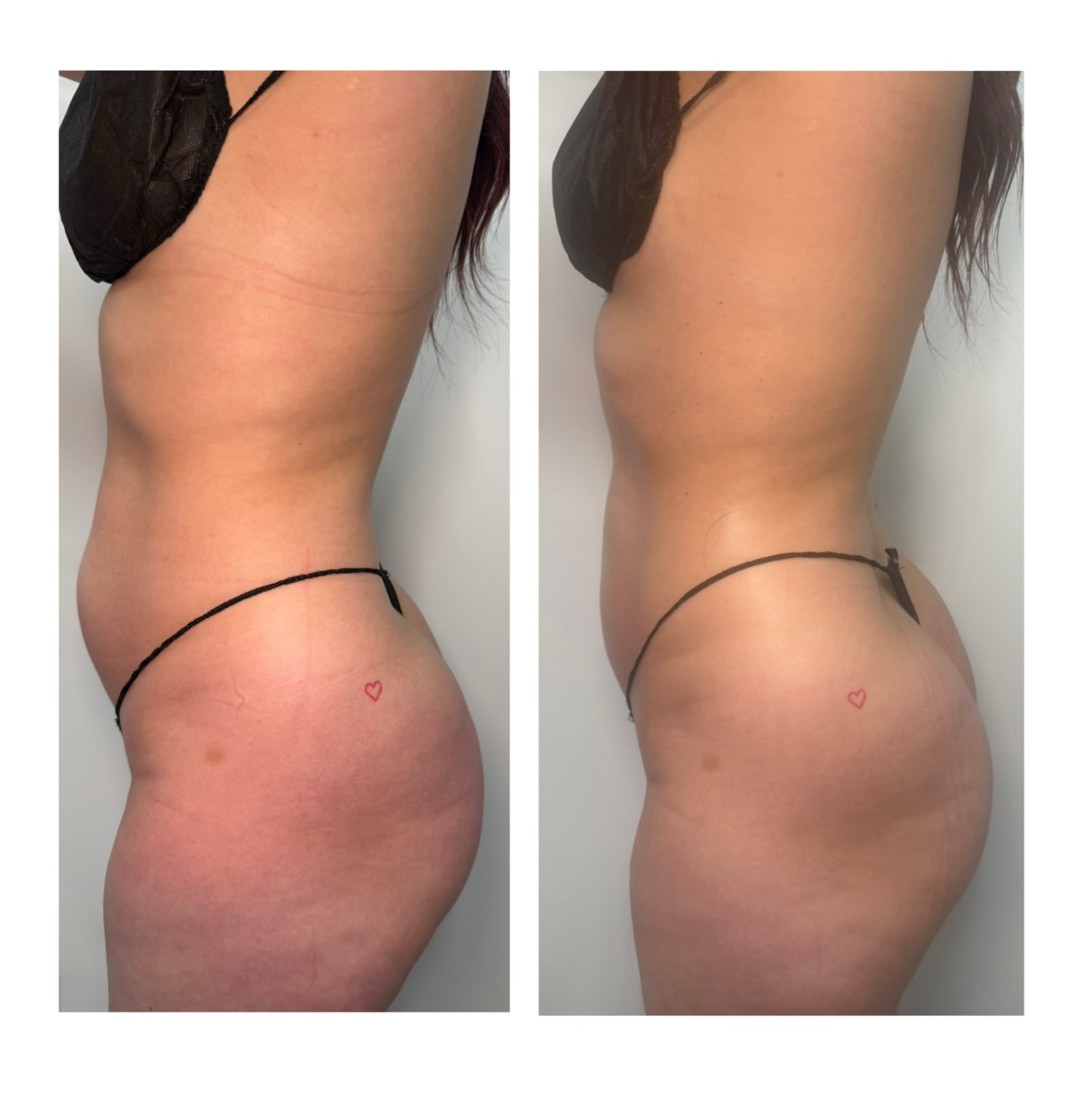 Brazilian Lymphatic Drainage with Colombian Wood Therapy
