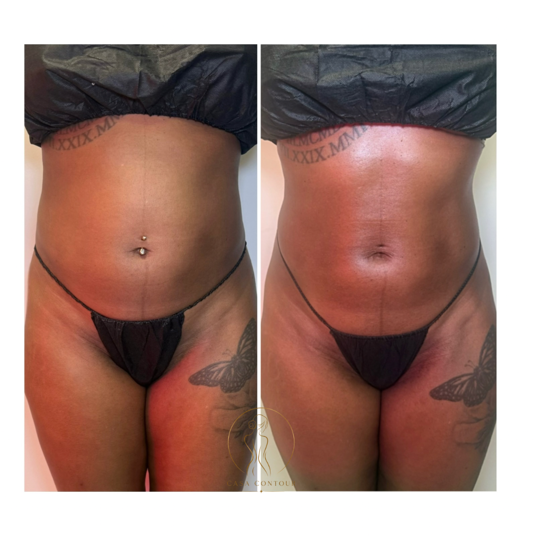 Brazilian Lymphatic Drainage with Colombian Wood Therapy