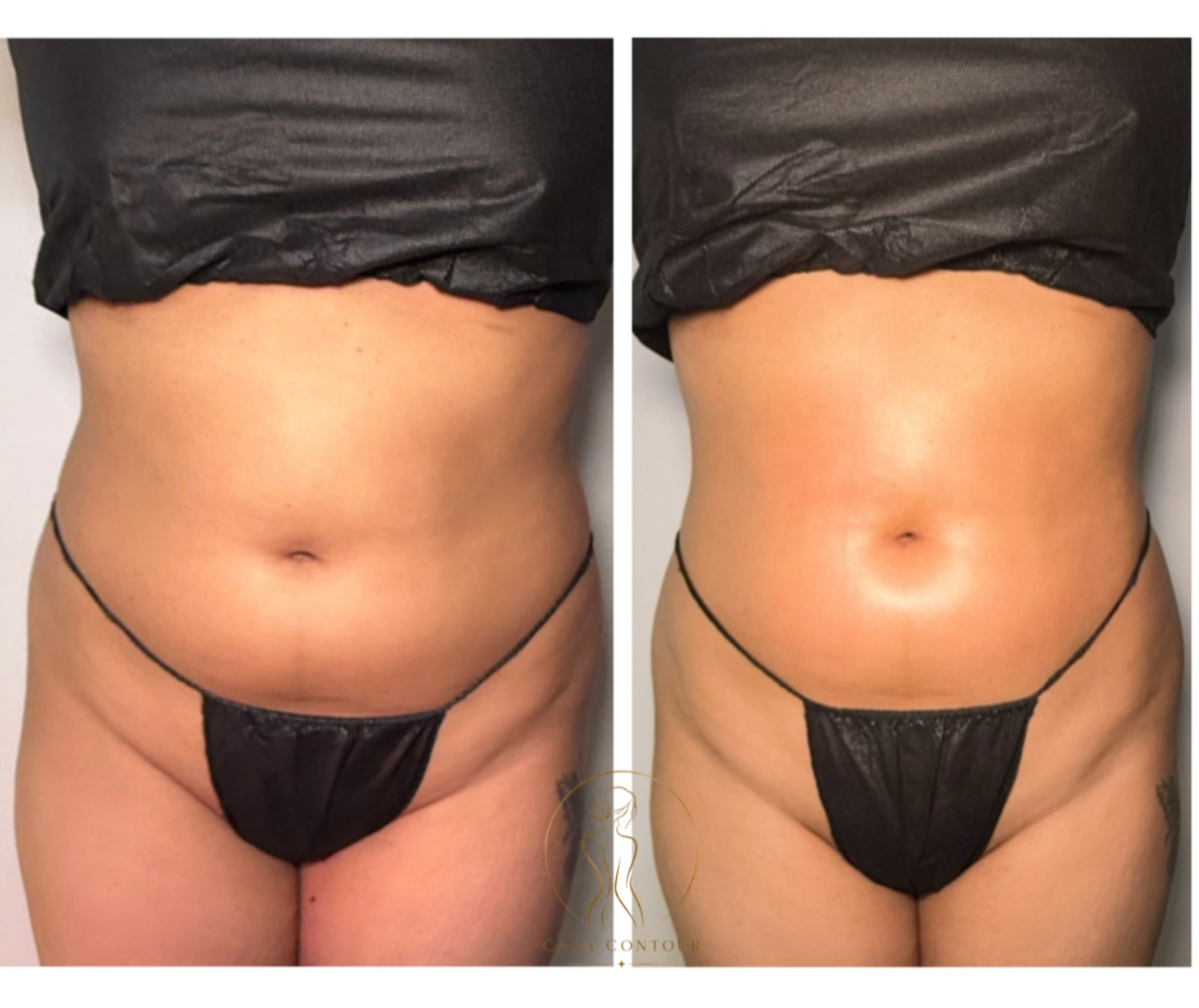 Brazilian Lymphatic Drainage in Edmonton