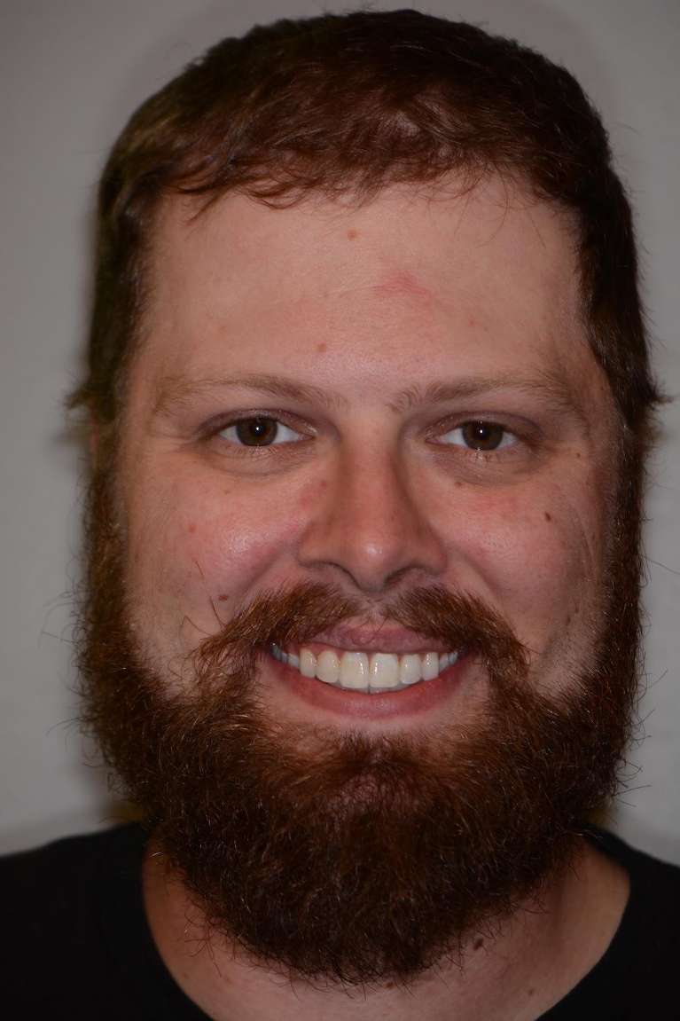 After Invisalign treatment smile photo
