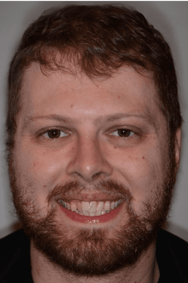 Before Invisalign treatment smile photo