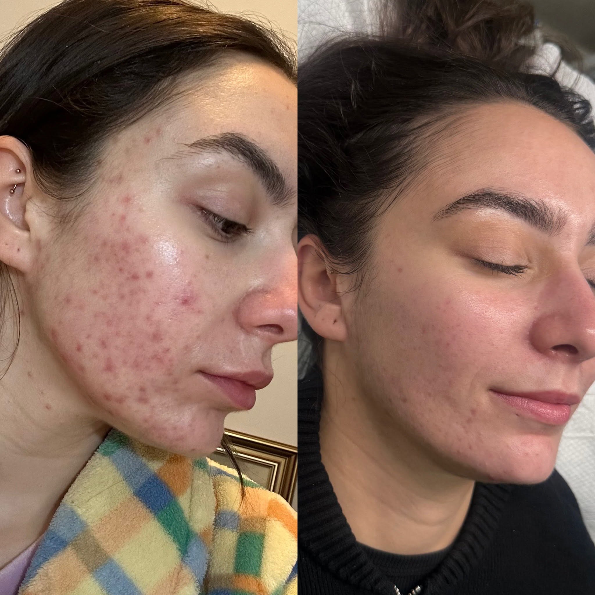 Before and after, genuine client skin journey 5 at Luminous Skin Clinic