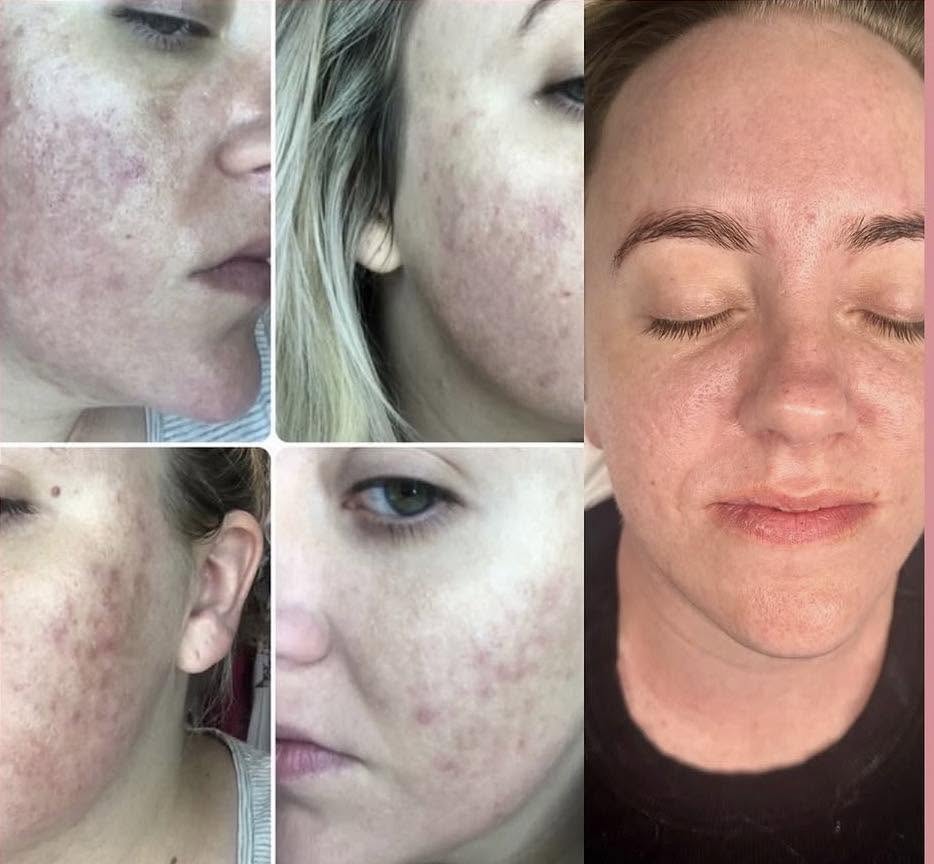 Before and after, genuine client skin journey 9 at Luminous Skin Clinic
