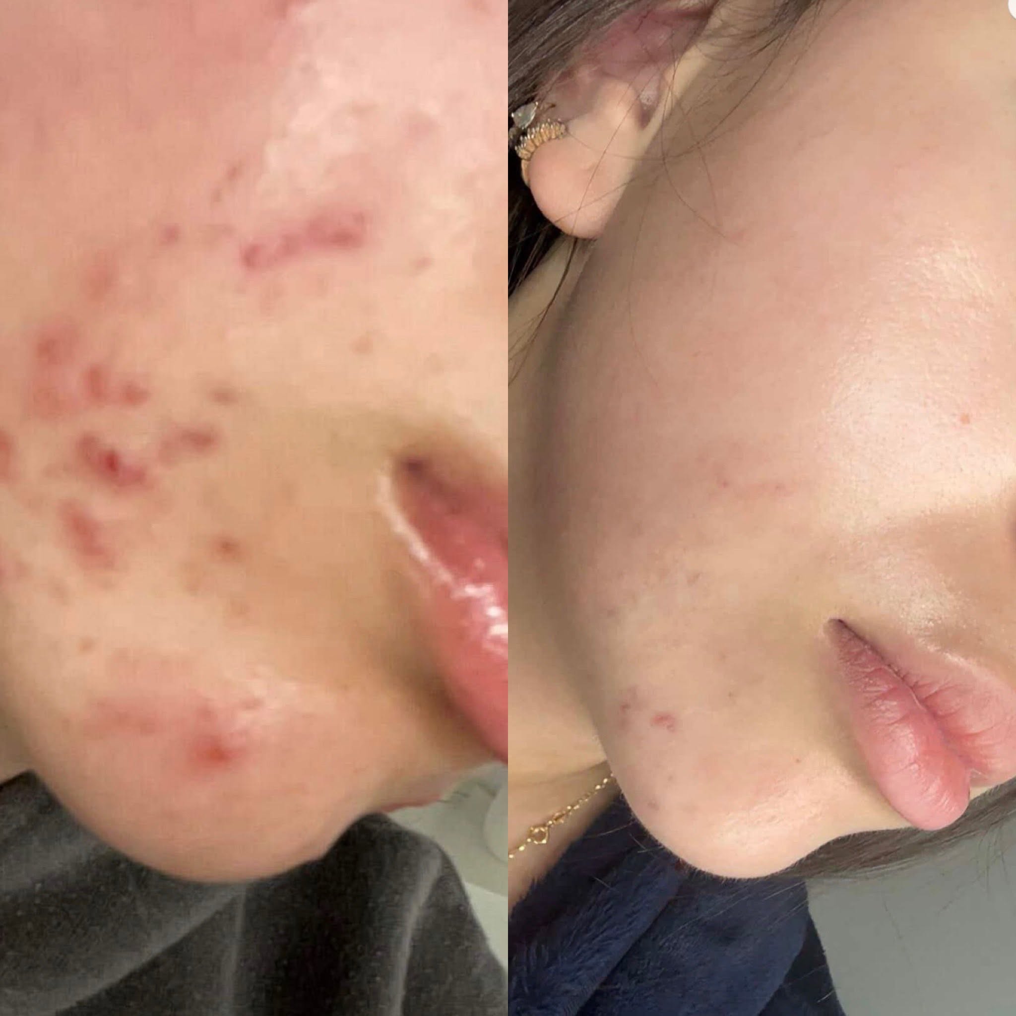 Before and after, genuine client skin journey 7 at Luminous Skin Clinic