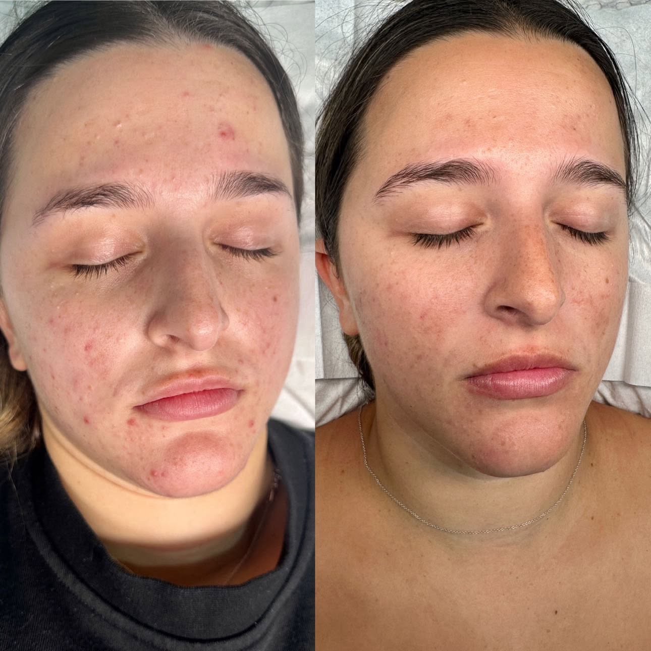 Before and after, genuine client skin journey 8 at Luminous Skin Clinic