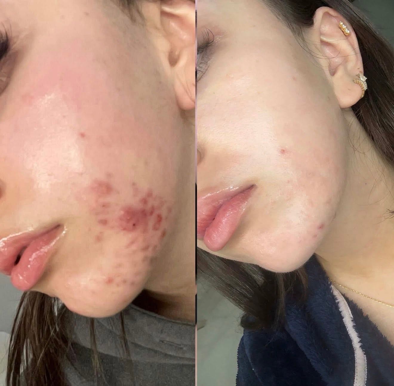 Before and after, genuine client skin journey 6 at Luminous Skin Clinic