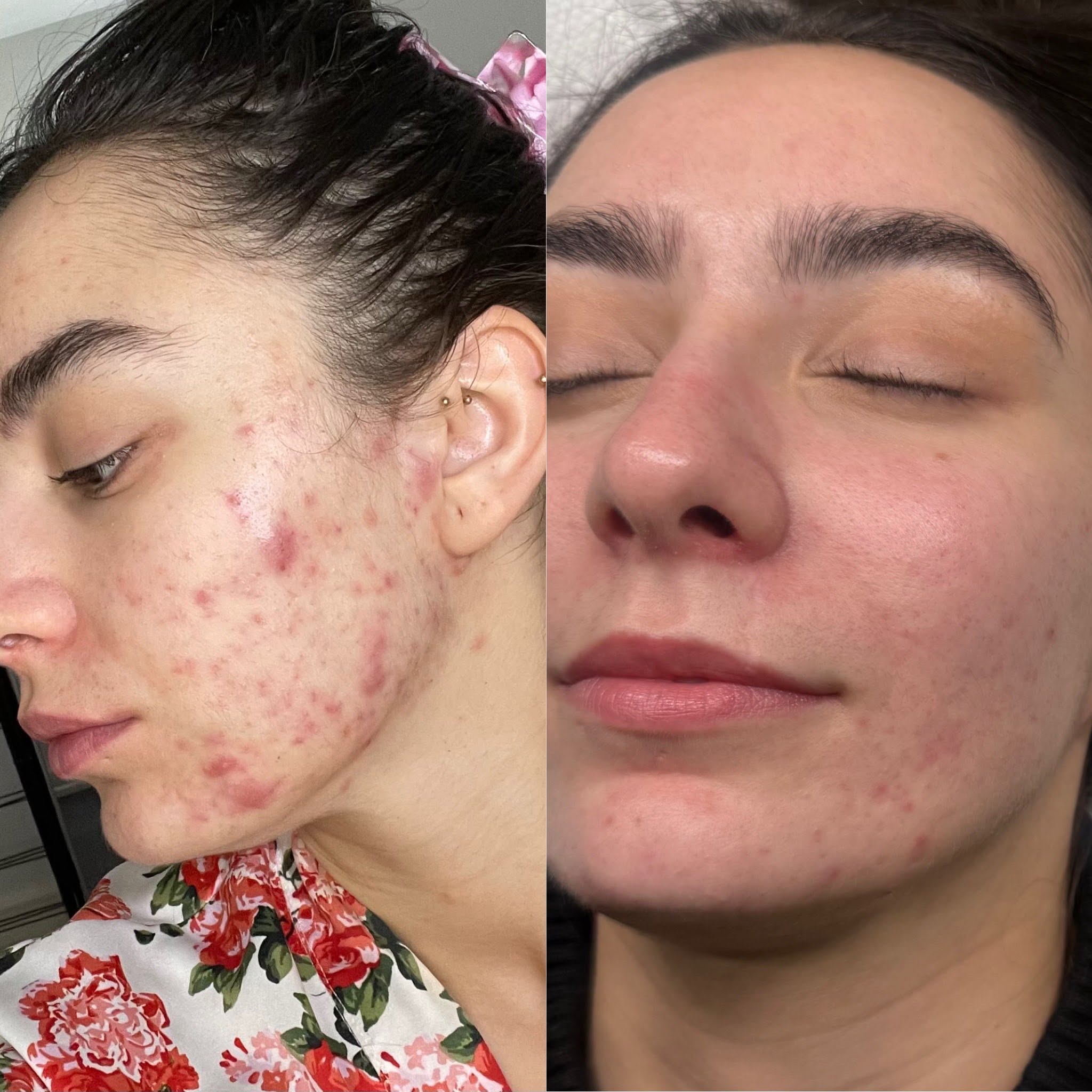 Before and after, genuine client skin journey 1 at Luminous Skin Clinic