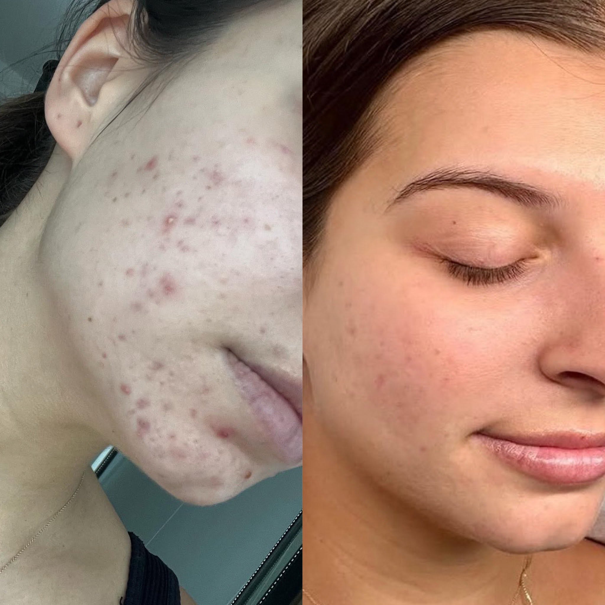 Before and after, genuine client skin journey 2 at Luminous Skin Clinic