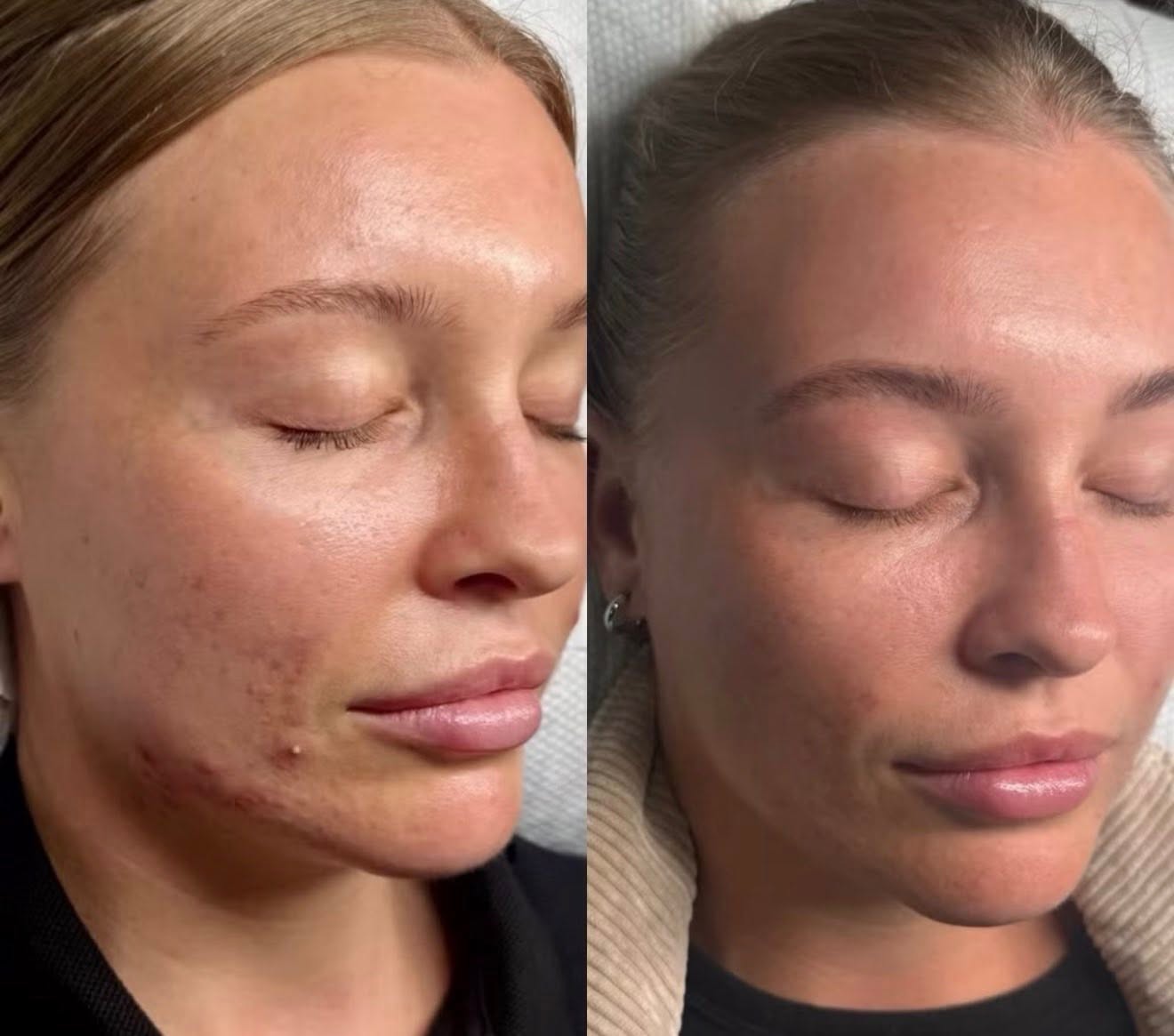Before and after, genuine client skin journey 4 at Luminous Skin Clinic