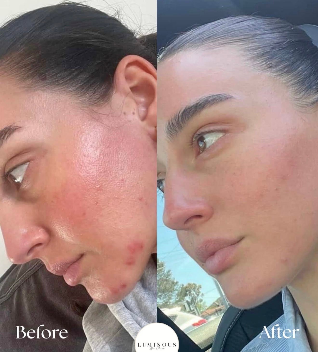 Before and after, genuine client skin journey 3 at Luminous Skin Clinic