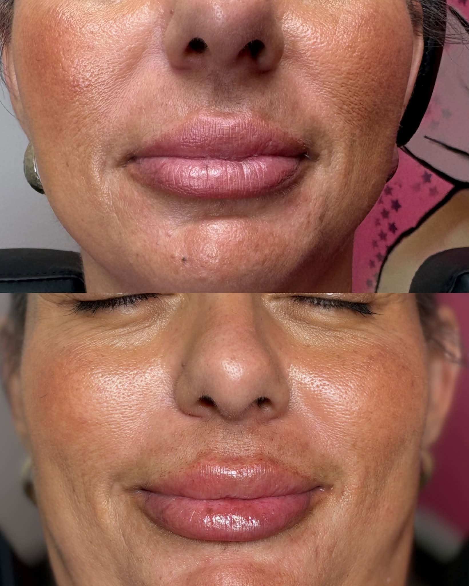 Before and after lip filler at Cove Aesthetics
