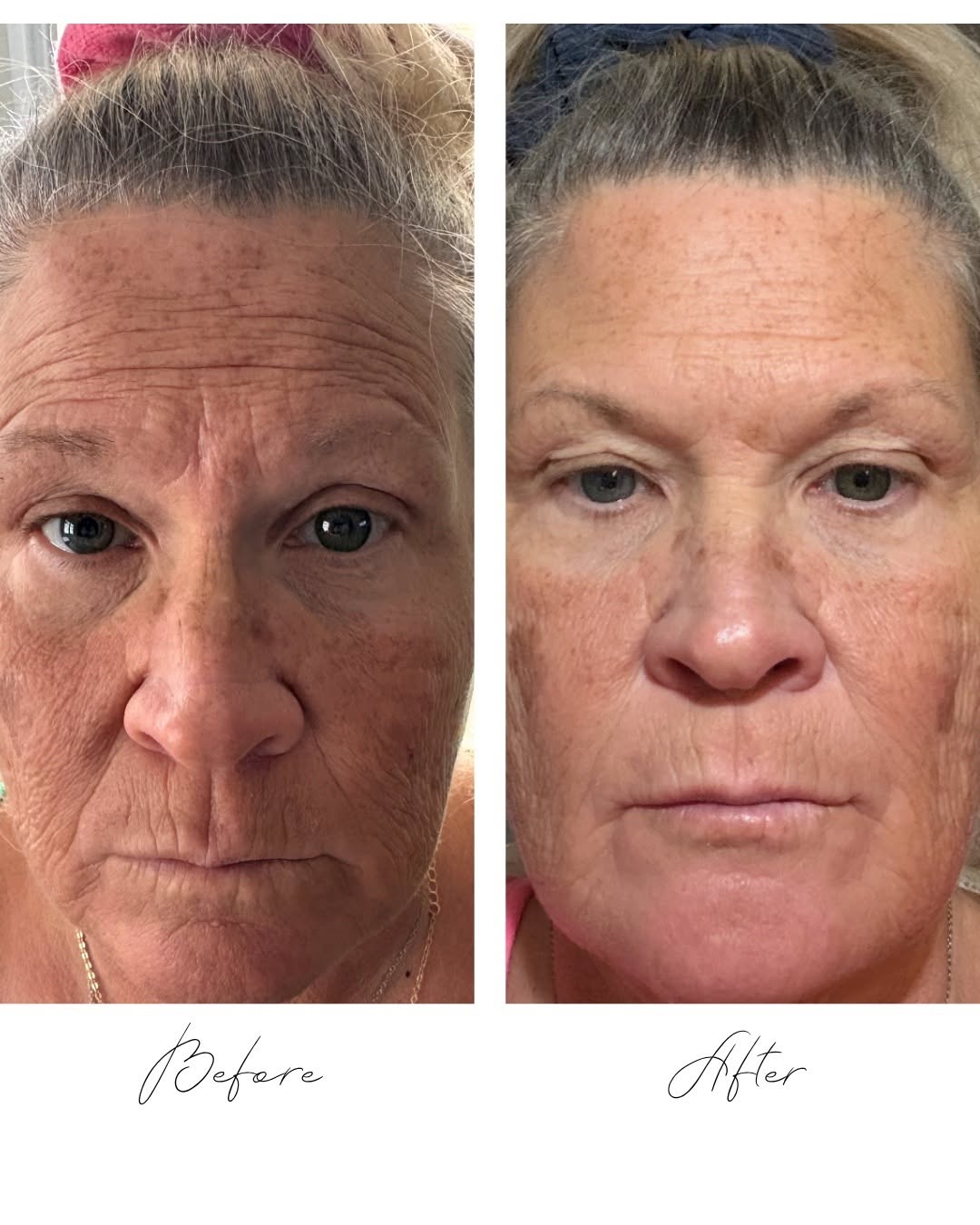 Before and after neurotoxin treatment on the forehead at Cove Aesthetics