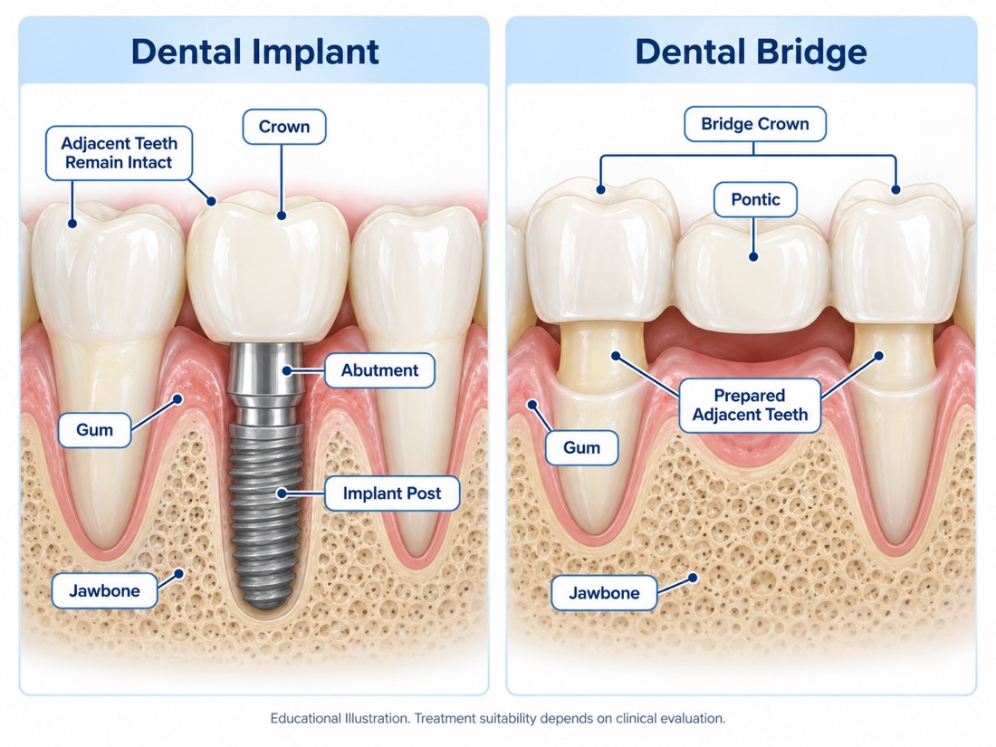 Illustration: dental implant compared with a bridge