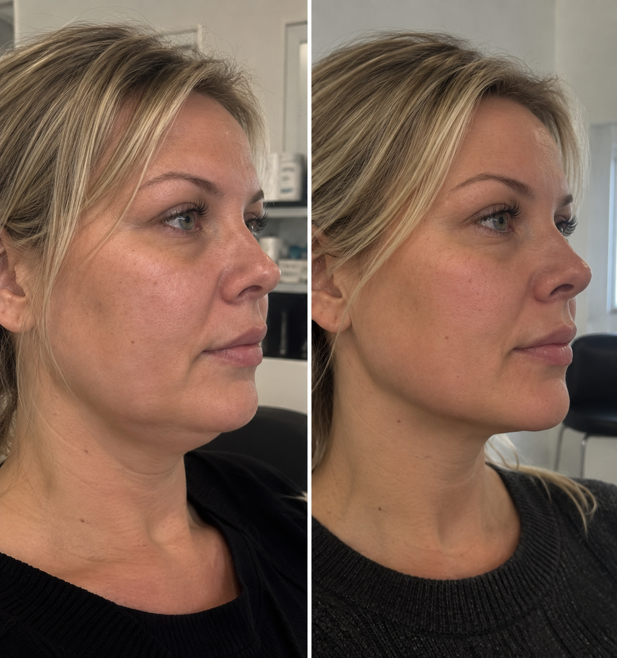HIFU käklinje resultat