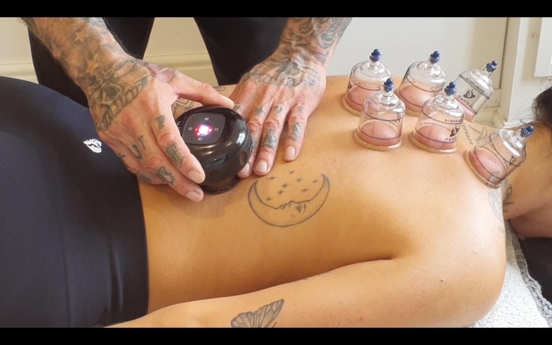 dry and wet cupping nottingham