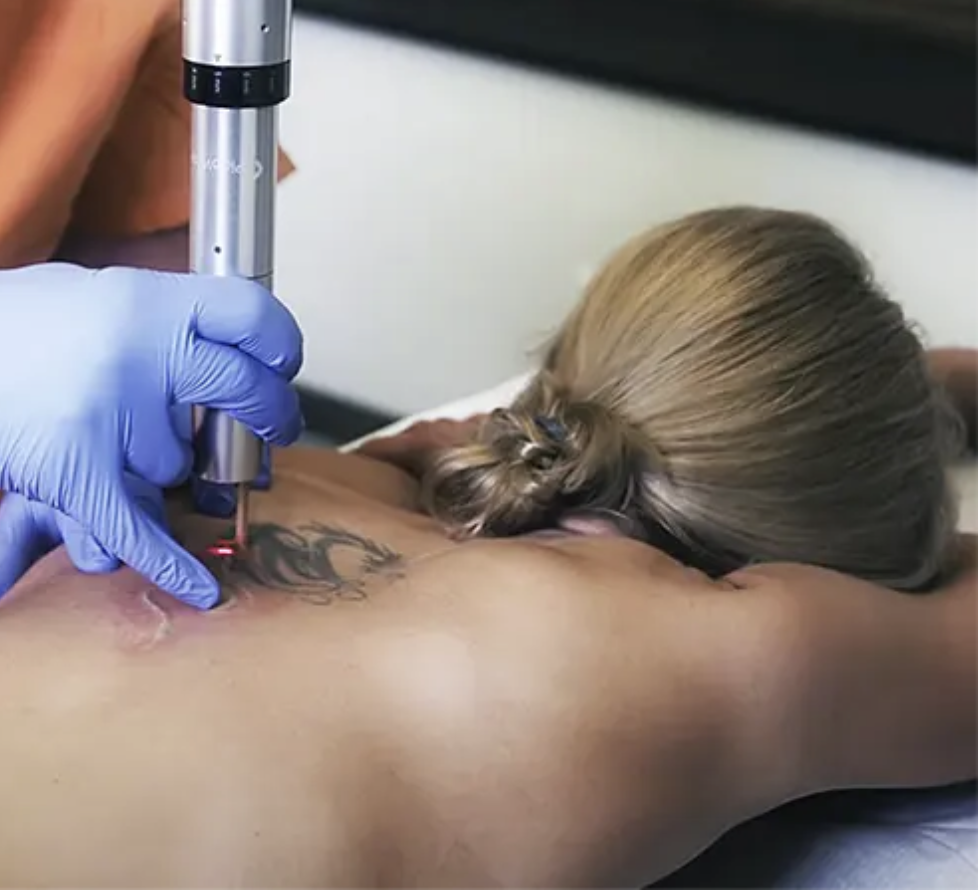 Laser tattoo removal at The Laserie