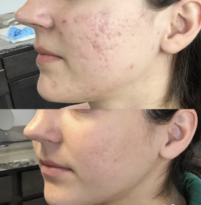 Microneedling at Polished Beauty Med Spa