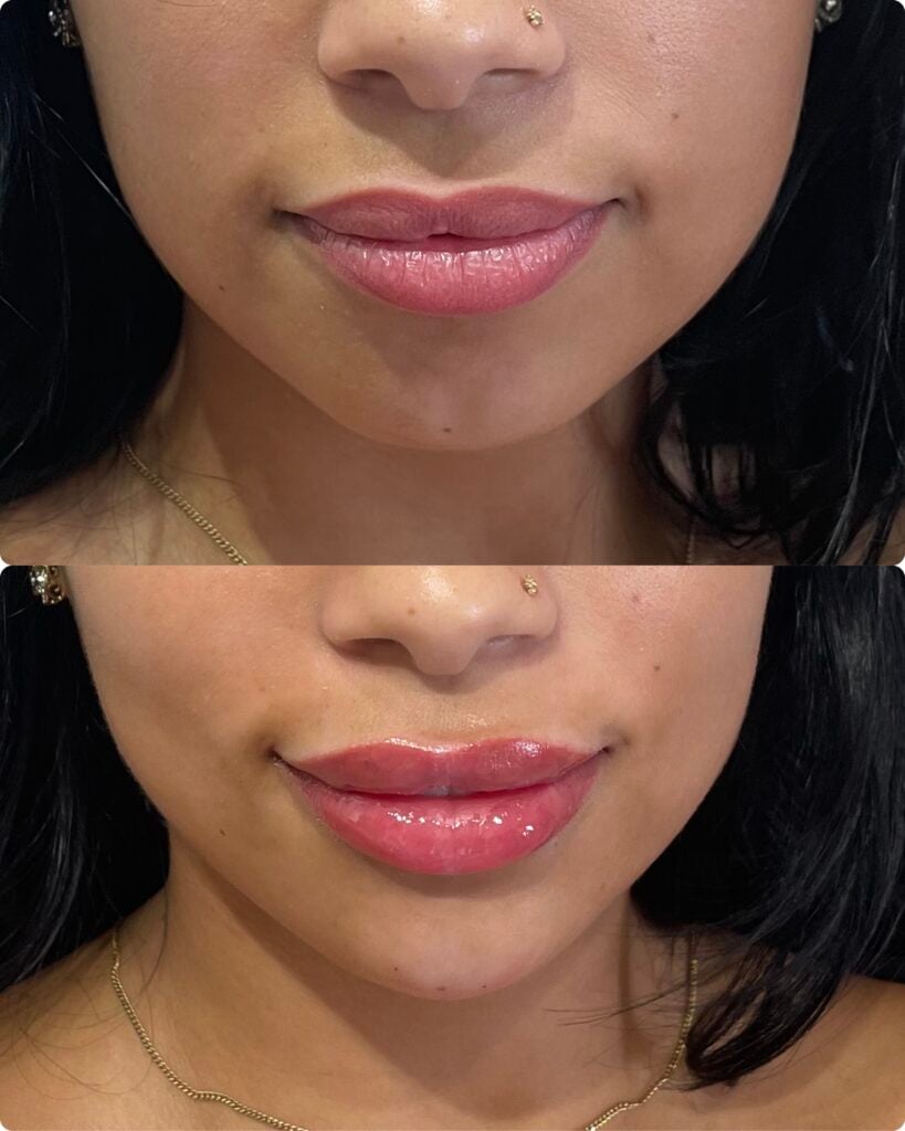 Fillers at Polished Beauty Med Spa