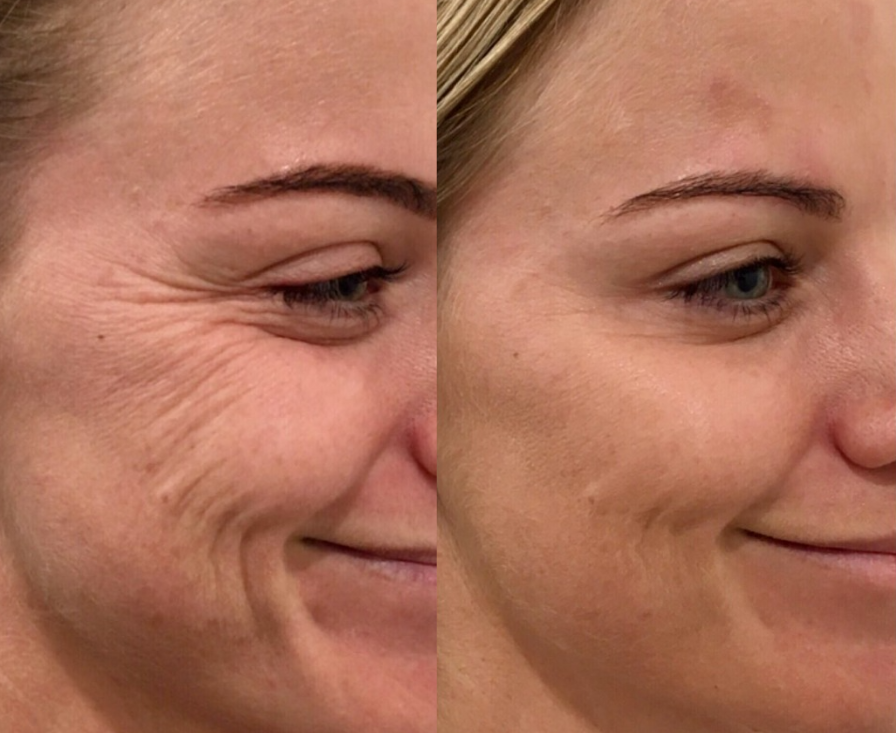 Wrinkle relaxers at Polished Beauty Med Spa