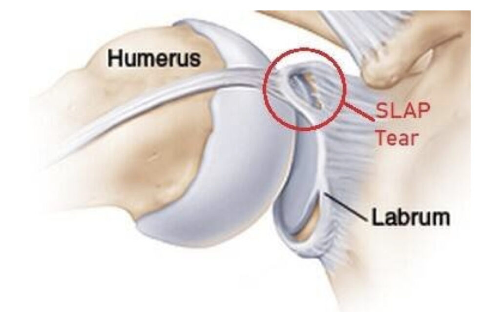 Approach Slap Understanding SLAP Tears in Baseball Players and How to Approach Rehab