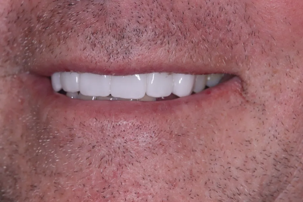 Patient smile with natural-looking dentures at GM Dental Barnet