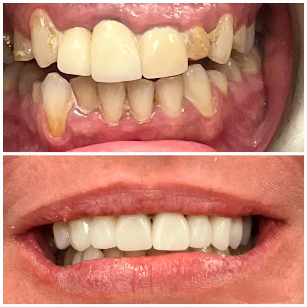 Dental bridge at GM Dental Barnet