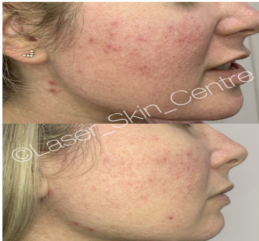 Before and after skin treatment at Laser Skin Centre