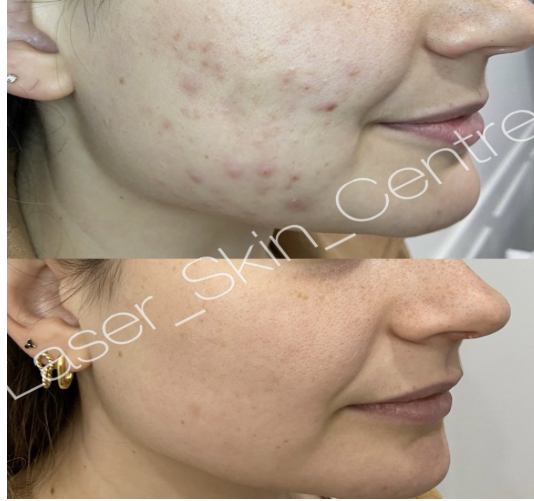 Before and after skin treatment at Laser Skin Centre