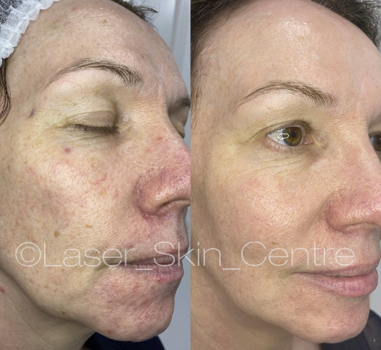 Before and after skin treatment at Laser Skin Centre
