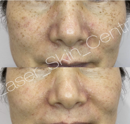 Before and after skin treatment at Laser Skin Centre